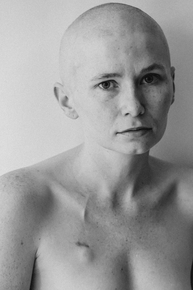 Bald Rhiannon Abshoff with scars from breast cancer therapy. 